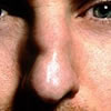 Eyelid Surgery